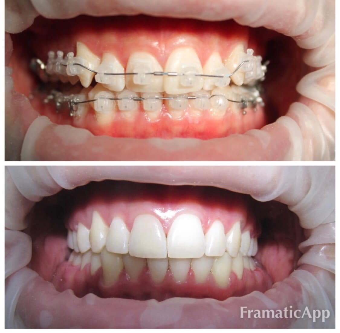 Photos before and after Orthodontology 8