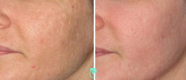 Фото до та після Лазерне шліфування шкіри обличчя 2