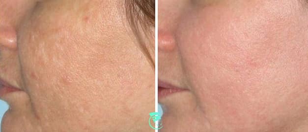 Фото до та після Лазерне шліфування шкіри обличчя 3