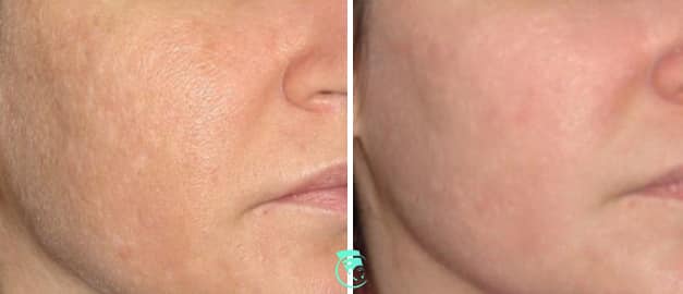 Фото до та після Лазерне шліфування шкіри обличчя 4