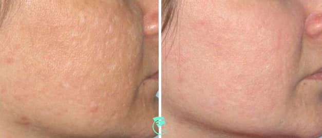 Фото до та після Лазерне шліфування шкіри обличчя 5