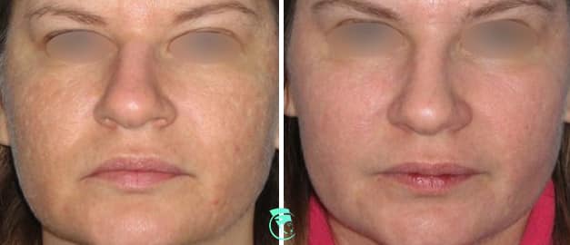 Фото до та після Лазерне шліфування шкіри обличчя 1