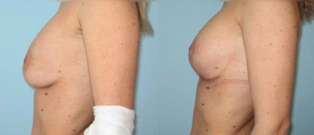Фото до и после Подтяжка груди (мастопексия) 15