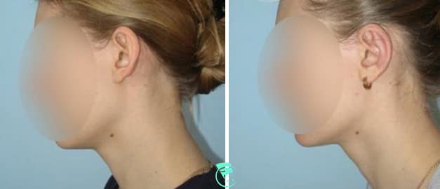 Фото до та після Пластика вух 39