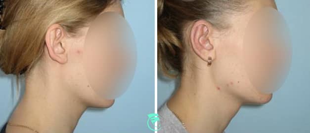 Фото до та після Пластика вух 40