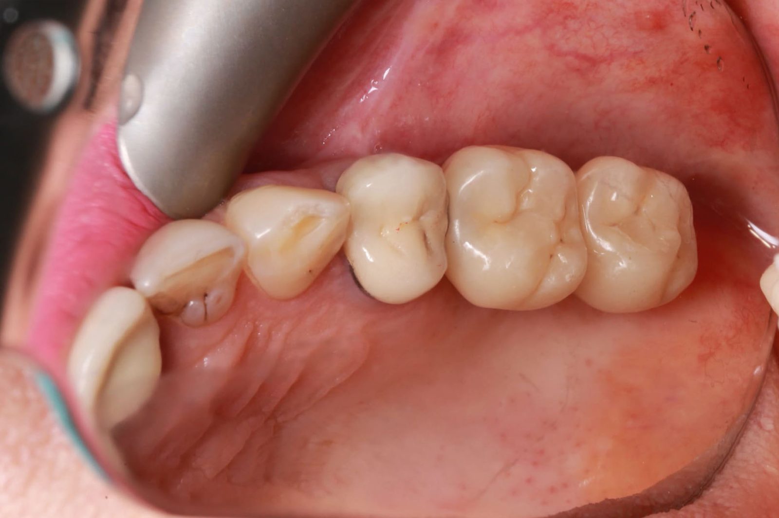 Фото до и после Имплантация зубов 3