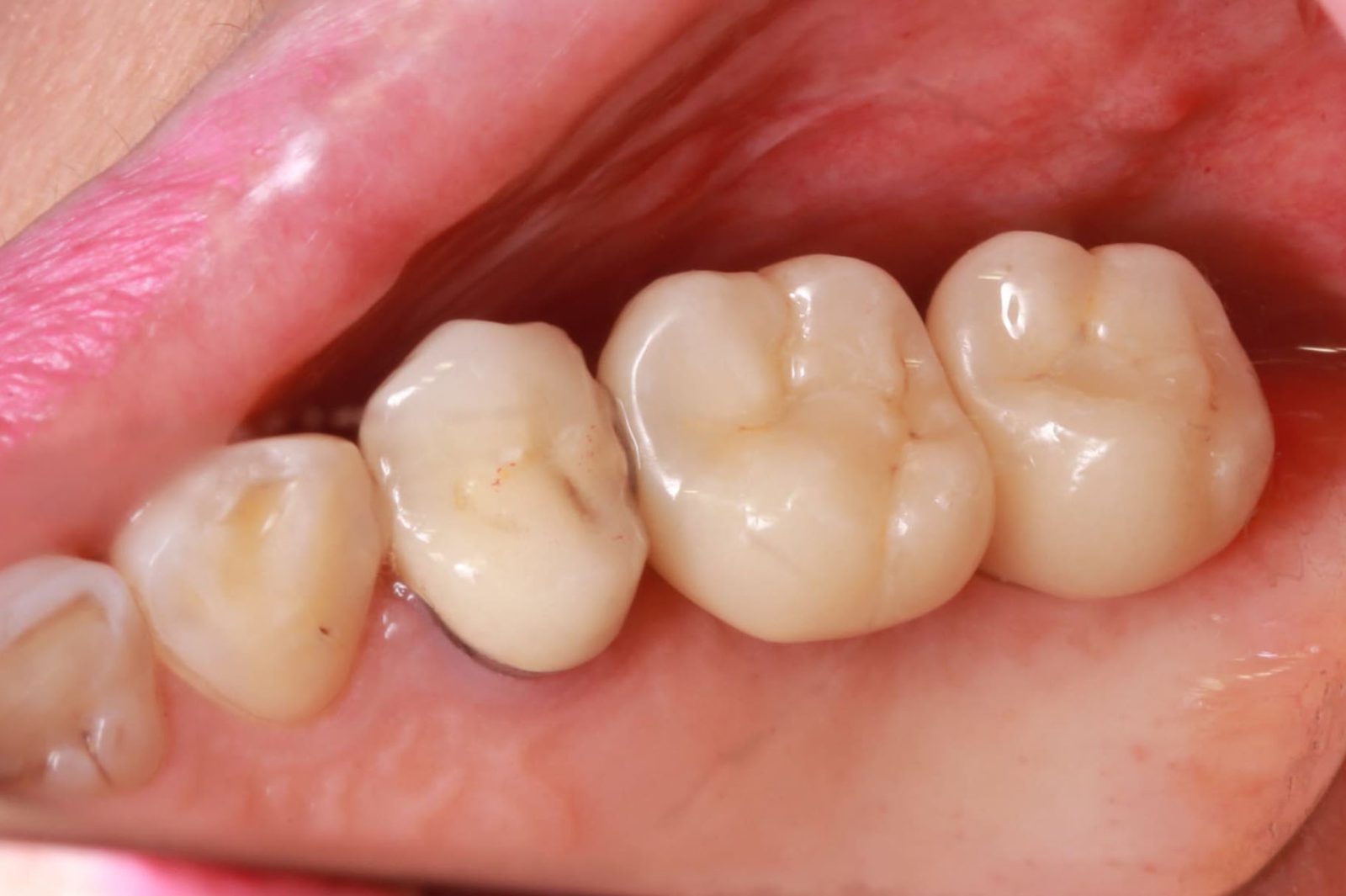 Фото до и после Имплантация зубов 4