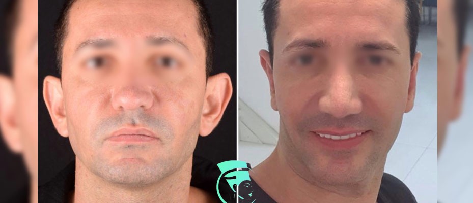 Фото до та після Пластика вух 6