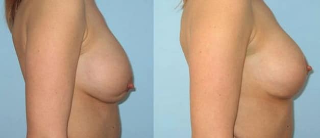 Фото до и после Подтяжка груди (мастопексия) 16