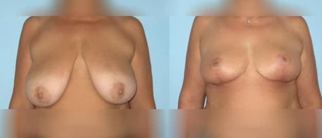 Фото до и после Подтяжка груди (мастопексия) 17