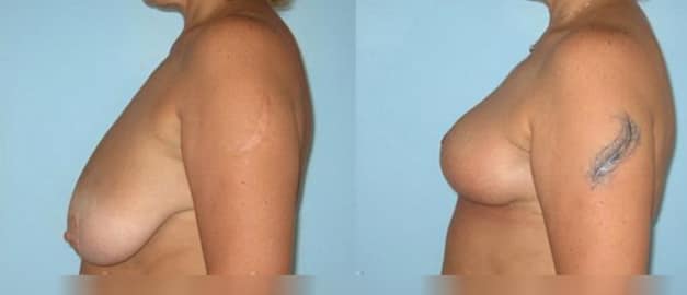 Фото до и после Подтяжка груди (мастопексия) 19