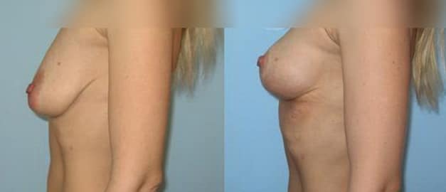 Фото до и после Подтяжка груди (мастопексия) 8