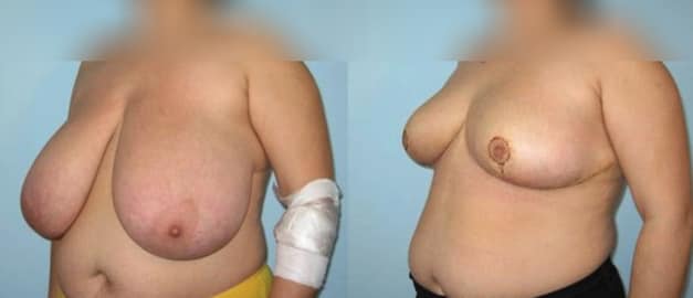 Фото до и после Подтяжка груди (мастопексия) 22