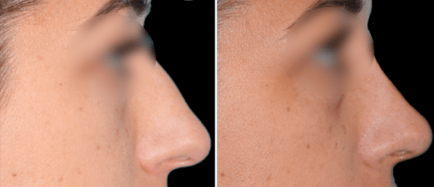 Фото до и после Ринопластика (пластика носа) 25