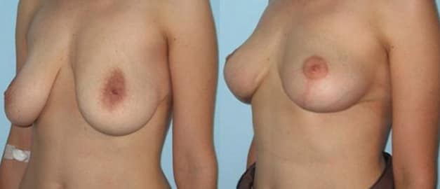 Фото до и после Подтяжка груди (мастопексия) 3