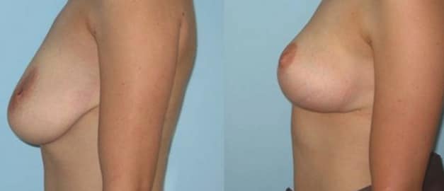 Фото до и после Подтяжка груди (мастопексия) 4