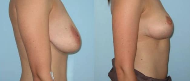 Фото до и после Подтяжка груди (мастопексия) 5