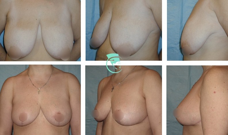 Фото до и после Уменьшение груди 6
