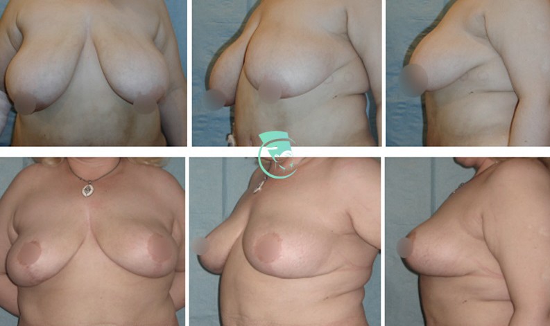 Фото до и после Уменьшение груди 8