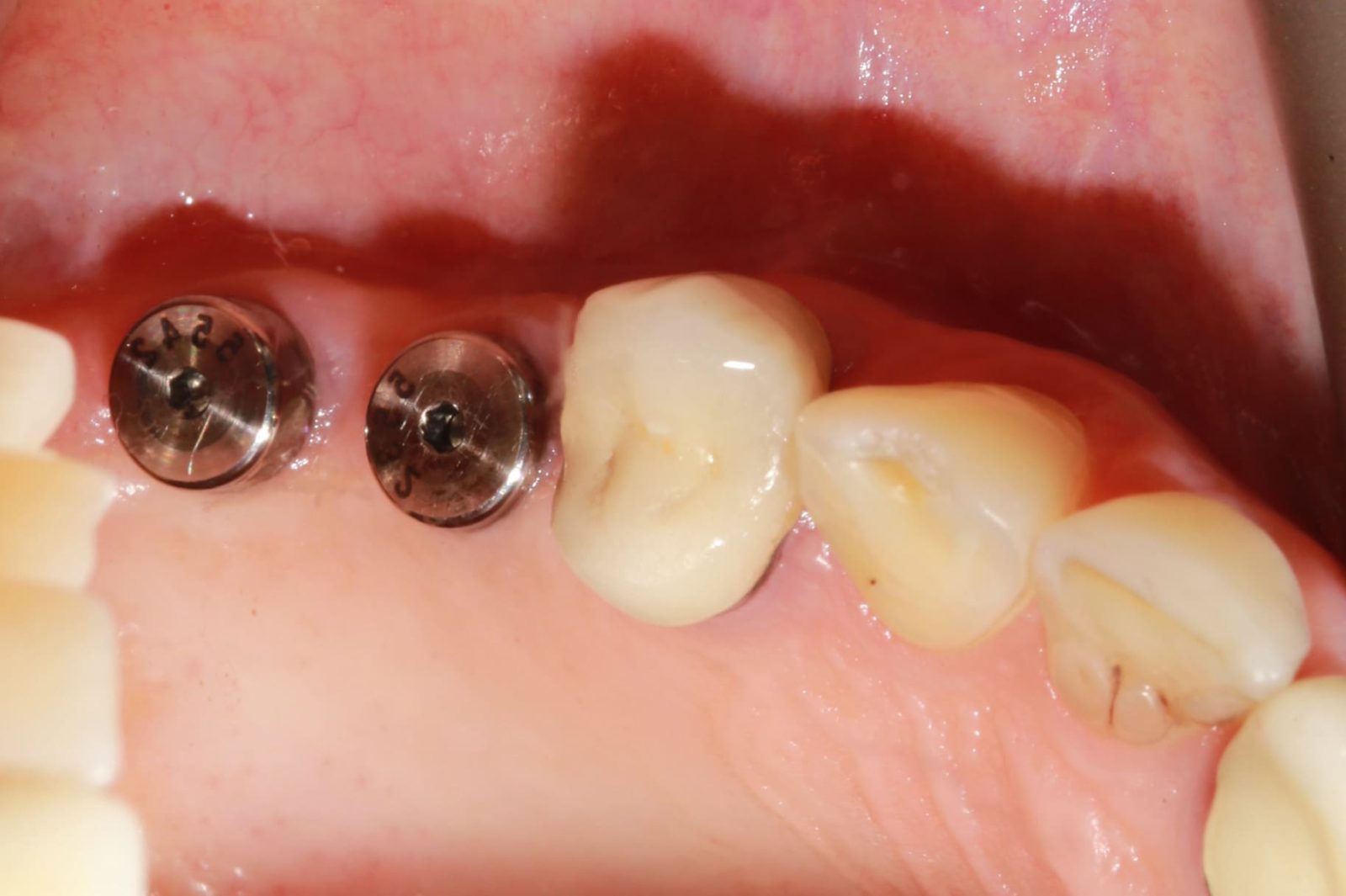 Фото до та після Імплантація зубів 1