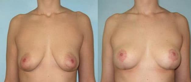 Фото до и после Подтяжка груди (мастопексия) 10