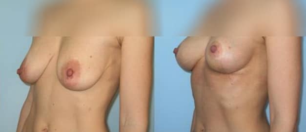Фото до и после Подтяжка груди (мастопексия) 13