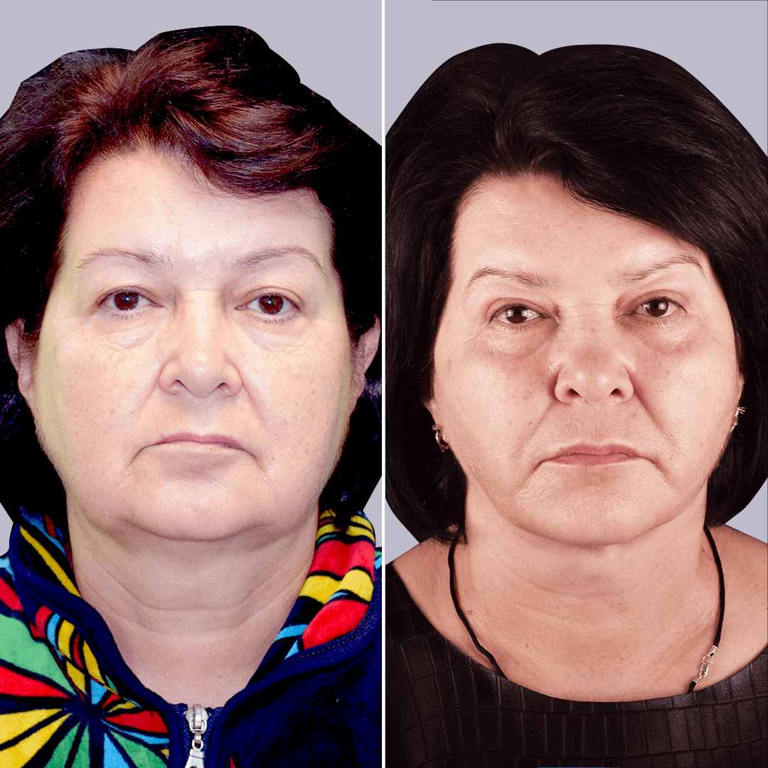 Фото до и после Подтяжка лица 13
