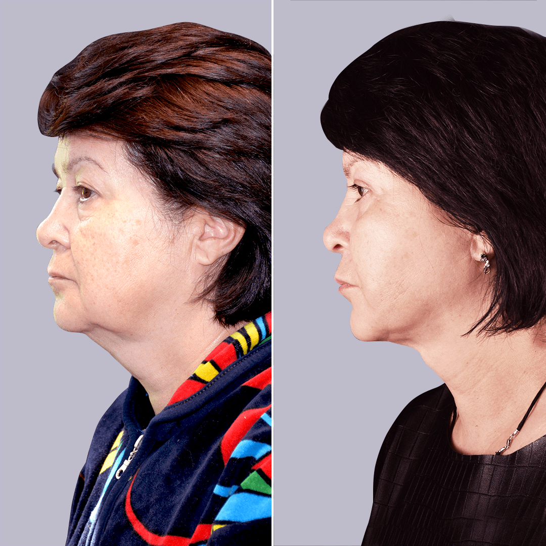 Фото до и после Подтяжка лица 12