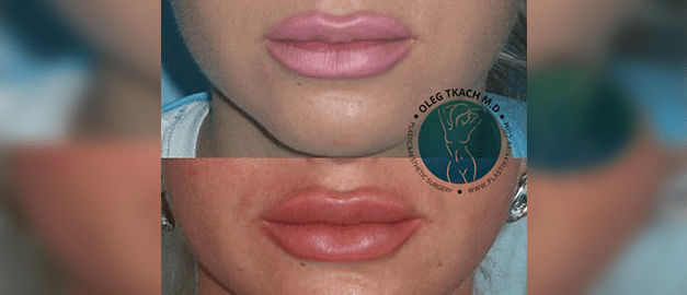 Photos before and after Сheiloplasty 13