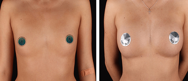 Фото до и после Липофилинг груди 5