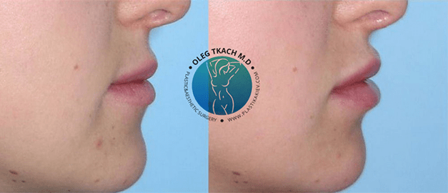 Photos before and after Сheiloplasty 26
