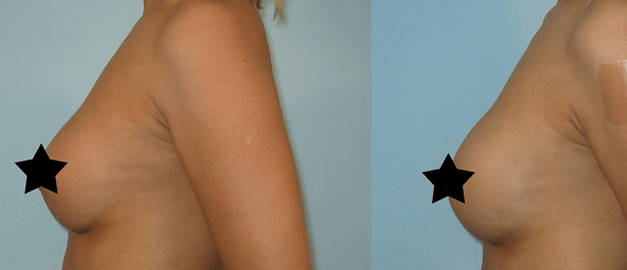 Фото до та після Ліпофілінг грудей 6