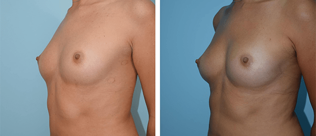 Фото до и после Липофилинг груди 7