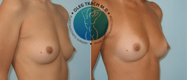 Фото до и после Липофилинг груди 8
