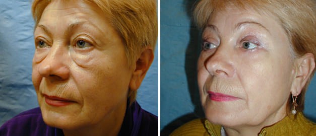 Фото до и после Подтяжка лица 49