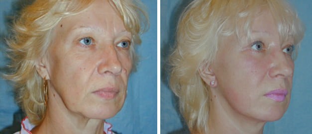 Фото до и после Подтяжка лица 50
