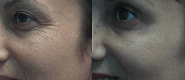 Фото до и после Инъекции ботулотоксина 1
