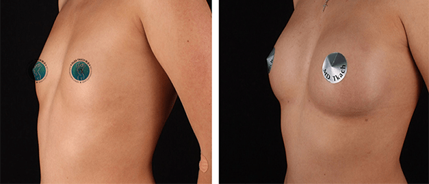 Фото до и после Липофилинг груди 10