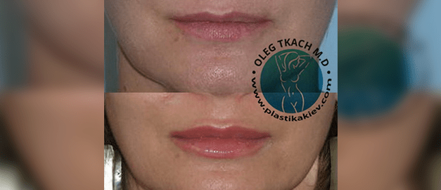 Фото до и после Пластика губ 15