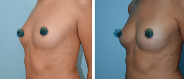 Фото до и после Липофилинг груди 13