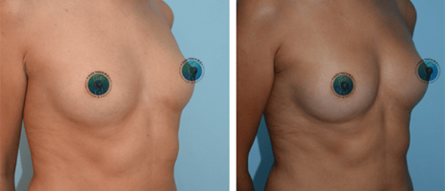Фото до и после Липофилинг груди 15