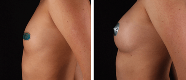 Фото до и после Липофилинг груди 11