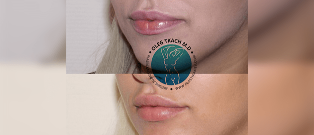 Фото до та після Пластика губ 16