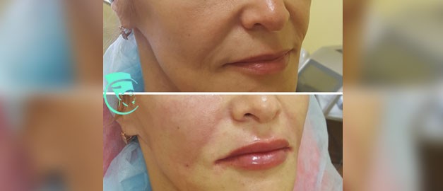 Photos before and after Filler Injections 8