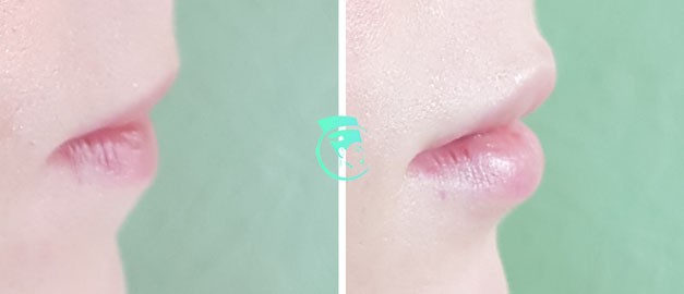Фото до и после Пластика губ 9
