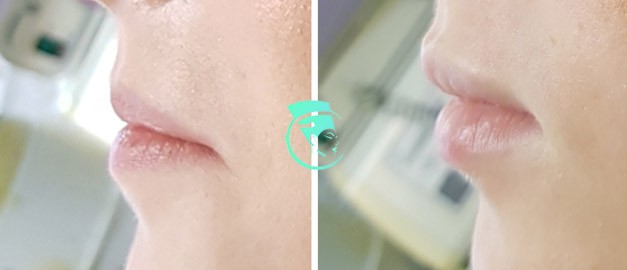 Photos before and after Filler Injections 9