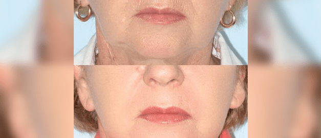 Фото до та після Лазерне шліфування шкіри обличчя 6