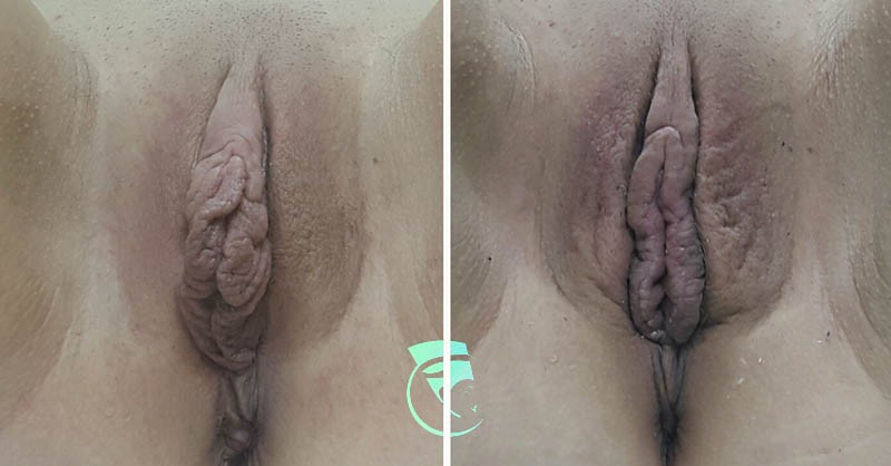 Фото до та після Лабіопластика (пластика статевих губ) 4