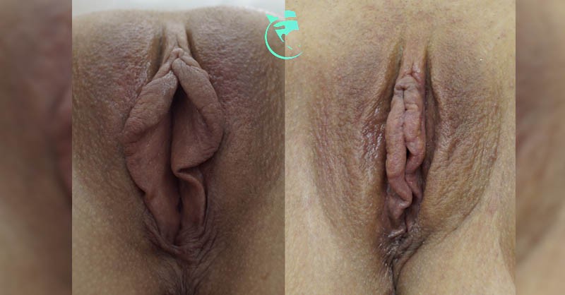 Фото до та після Лабіопластика (пластика статевих губ) 7