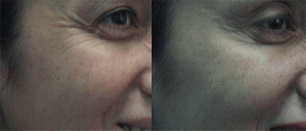 Фото до и после Инъекции ботулотоксина 2